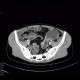 Crohn's disease, stenosis, prestenotic dilatation, CT enterography at 3 years: CT - Computed tomography